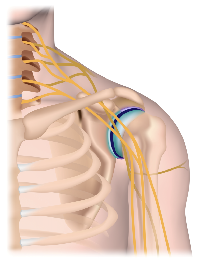 Plexus brachialis en cervicale klachten met Ad Warmerdam DO
